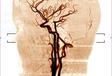 뇌혈관 터질까 전전긍긍…병력만 알아도, 정신질환 위험 높이는 '병'