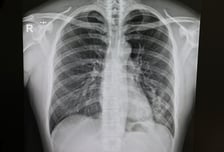 감기로 착각, 때 놓쳤다…"먹는 약도 소용 없어" 이 병 입원 10배 '쑥'