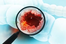 직장암 수술 전 '항암·방사선 치료' 동시 시행하면 항문 보존 가능성↑