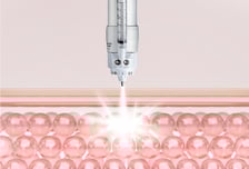 피부 안 찔러도 주름 지운다? "바늘 없는 필러주사가 더 효과적"