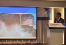 "피 흘릴 정도로 박박" 극심한 가려움…'건선' 중증도 기준 달라진다