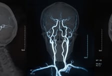 "골든타임 4.5시간"…아빠 말이 갑자기 어눌해졌다면 '이 증상' 의심을