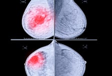 정부 연구기관 "유방암 수술 후 검사, 자주 받아도 생존율 큰 차이 없어"