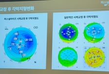 시력 1.5 되찾아 좋아했는데 '빛번짐'?…새 시력교정술 나왔다