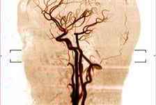 뇌경색 환자, 혈관 뚫은 뒤 '적극적인 혈압 조절' 더 안 좋아…왜?