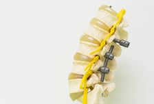 "허리 수술해도 아파" 3명 중 1명이 끙끙…S라인 지킬 '이 수술'이면 안심