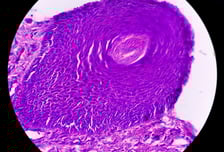 얼굴에 난 점, 점점 커지더니 암?… 눈 쌓인 날, 선크림 발라야 하는 이유