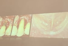 "나도 임플란트 했어"…한국인들 유독 수술 많이 하는 뜻밖의 이유