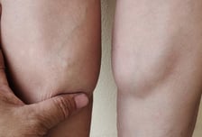 "아빠 종아리살이 쏙 빠졌네" 이 정도면 위험 신호…손가락 진단법