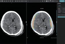 제이엘케이, 두개내출혈 검출 AI 솔루션 FDA 승인 획득