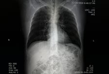 폐암 수술환자 10%에 숨어있던 '임파선 전이', CT로 예측한다