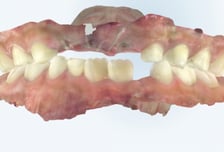 "와자작" 부럼 깨다 우리 아이 유치 '쏙'…"영구치 나잖아" 방심했다간
