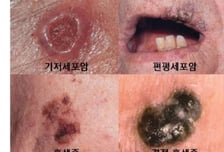 점 인줄 알았는데 암이라고?…꼭 체크해야 할 위험 신호 5개