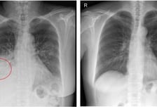 "적갈색 가래, 파란 입술 방치했다간…" 서희원 걸렸던 폐렴의 원인은?
