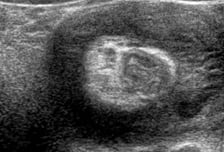 "아들, 감기 다 나았네" 한시름 놨는데…공포의 '장 도넛', 목숨도 위협?