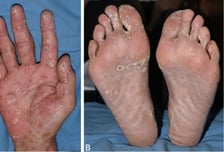 "성관계 후 걸렸어요"…일본서 폭증하더니 한국 덮친 '이 병'