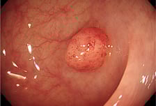 "용종 5개" 대장내시경 후 깜짝…최대 몇개까지 뗄 수 있을까?[한 장으로 보는 건강]