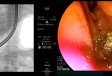 기름진 음식 먹고 명치 '쿡쿡', 황달까지…응급실 간 여성 몸속에 '이것'