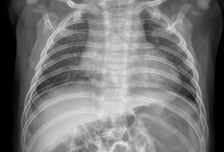 100일 갓 지난 영아, 국내 첫 '신종 코로나'…폐렴·간 기능 이상 동반