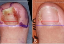 걸을 때마다 아프고 진물·고름…내성발톱, 안 뽑아도 된다