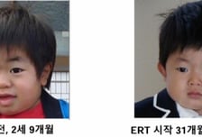 "유치원생이 틀니를" 진단 늦으면 '사망' 이 병…한국은 뒷걸음?