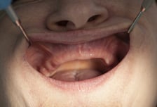 괜찮아지겠지…붓고 피 나는 잇몸 방치했다가 당뇨·뇌졸중까지