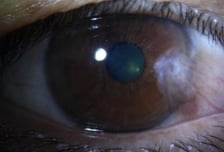 "충혈된 눈이 비상 신호였어" 각막 변형→건조증 악화…'이 병' 뭐길래