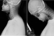 당신의 목 사진은 왼쪽? 오른쪽?…스마트폰 자주 봤더니