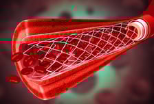혈관 스텐트 환자, 아스피린보다 더 좋은 '이 약'…심근경색 46% ↓