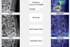 MRI 없이 진단 어려운 요추협착증, '정확도 91.4%' 엑스레이로 찾는다