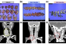 "항암제도 안 들어" 전이암 막막했는데…치료 단서 찾았다