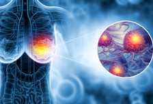 "유방암 예후 예측 정확도↑" 한국산 '온코프리', 맞춤 치료 시대 열까