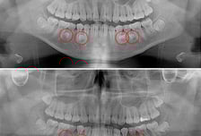 삐뚤빼뚤 치아, 숨기기만 급급했는데…뜻밖의 '구강 내 시한폭탄'
