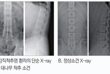 잘 잤는데 허리 통증 "디스크 아닙니다"…대나무 척추 만드는 '이 병'