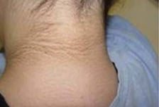 "때 낀듯 거뭇거뭇" 검게 변한 목덜미·겨드랑이…원인은 '이것'