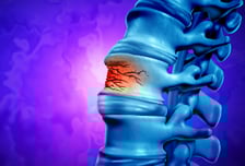 오래 쓰면 뼈 약해지는 '골다공증 치료제' 부작용 줄인 새 치료제 나오나
