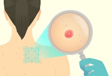 한국서 갑자기 늘어난 이 암…얼굴·몸에 생긴 '이것' 잘 살펴야