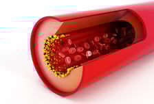 만성 간질환자 먹지 말라더니…오히려 간암 막아준 '고지혈증 치료제'