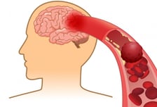 '어버버' 하더니 금세 멀쩡…"컨디션 나쁜가 봐" 넘기면 안 되는 이유