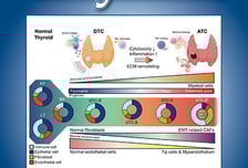 착한 암? NO!…韓 연구진, '나쁜 갑상선암' 치료 실마리 찾았다