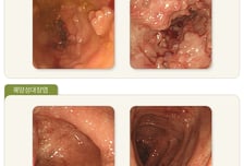 "윽, 화장실 좀…" 사라졌다 다시 생기는 '이 병' 2030 덮쳤다