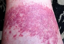 뙤약볕 골프 치고 나니 온다리에 붉은 반점…'디즈니 발진' 뭐길래