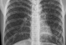 "폐암 검사 아냐?" 오히려 조기 발견 방해…환자단체 목소리 내는 이유