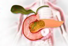 선진국서 발병 잦은데 '5년 생존율 16.5%'…잡스 앗아간 '침묵의 암살자'