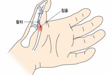 골프 시작했더니 손가락 왜 이래…펼 때마다 '딸깍' 통증 줄이려면[한 장으로 보는 건강]