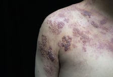 "3명 중 1명 걸린다"…찌르는 듯한 통증→띠모양 수포, 3일 넘겼다간