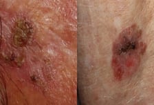 이런 '점' 암이라고? 가렵지도 아프지도 않았는데…눈으로 보는 구별법