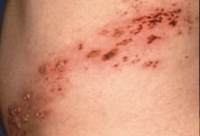 "스치기만해도 끔찍 고통" 로제도 앓은 '이 병'…2030도 노린다