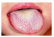 "대표 증상은 딸기 혀"…요즘 유행하는 '성홍열', 여름 감기로 착각?