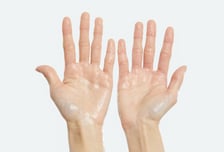 '땀 범벅' 다한증 환자, 손 수술했더니 가슴서 땀 폭발?…사실일까